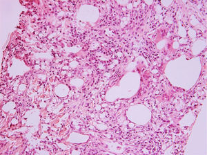 Hematoxylin- and eosin-stained slide (×200) of patient's lung tissue. Instead of normal alveoli in the lung, there are empty spaces of different sizes, lined with partially flattened multinucleated giant cells. Between those empty places, there is fibrous connective tissue, sometimes with infiltration of lymphocytes. In the connective tissue, there are also foreign body granulomas with large multinucleated cells that have vacuoles in the cytoplasm. The lesions do not have a distinct margin from the normal lung.