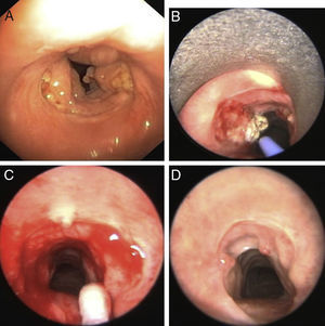 Case number 11 – Fig. 1 and Table 1. (A) Stenosis (∼75%) with exuberant granulation tissue; (B) APC; (C) MMC application after RB dilatation; and (D) final stenosis (∼25%), with rare granulation tissue 2 months after first MMC session.