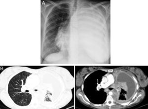(A) Chest X-ray showing total left lung opacity with contralateral mediastinal deviation. (B) Chest CT showing large mass in the left pulmonary hilum involving the pulmonary artery and the left main bronchus, as well as large left pleural effusion with pleural thickening.