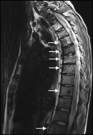 Spine magnetic resonance imaging showing secondary involvement of the vertebrae C7 and T1–T10 (arrows), and intramedular metastasis extending from T3 to T7.