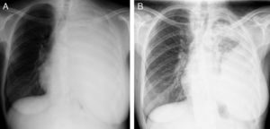 (A) Chest X-ray when patient started crizotinib. (B) Chest X-ray after 8 months of treatment with crizotinib.