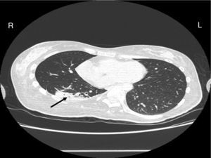 Chest CT scan at day 12: partial regression of the atelectasis.