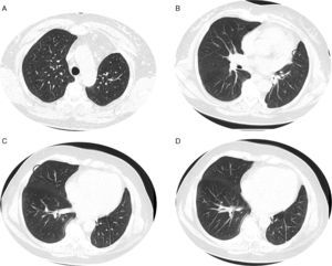 Axial sharp algorithm CT images of chest (B; D) and axial high‐resolution CT images (A; C): few visible lucencies (blue circles) of small dimensions, similar to each other and distributed throughout the lungs, well defined with a discernible wall, some of them surrounded by slight ground‐glass opacities (C).
