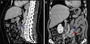 Contrast‐enhanced abdominal CT scan, sagital (A) and coronal (B) images show tubular low‐attenuation retroperitoneal cystic masses, which are consistent with dilatation of the abdominal lymph vessels (blue arrow). Enlarged para‐aortic lymph node (red arrow).