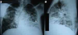 Chest radiograph on admission (A: posteroanterior and B: lateral view) showing multiple thin‐walled cyst (pneumatoceles) with air‐fluid level (*).