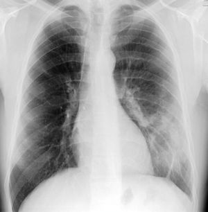 Chest X-ray (postero-anterior incidence) – demonstrating inferior unilateral rib notching of 4th to 7th left ribs, hypotransparent inferior third of the left lung and homolateral vascular prominence.