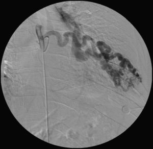 Image of the selective angiography of the 7th left intercostal artery demonstrating, an exclusive arterial anastomosis with homolateral pulmonary artery.