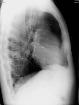 Chest X-ray (lateral incidence) demonstrating inferior left lung hypotransparency.