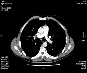 Axial image of the Thoracic Angio – CT, demonstrating relative low enhancement of the left branch of the pulmonary artery when compared to contralateral branch.