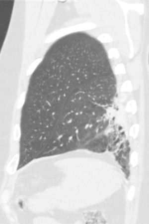 Sagital CT image (lung window) demonstrating traction bronchiectasis and bronchiolectasis in subpleural location in the left lower lung.
