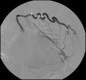 Image of the selective angiography of the 4th left intercostal artery demonstrating increased caliber and tortuositiy of the intercostal artery.