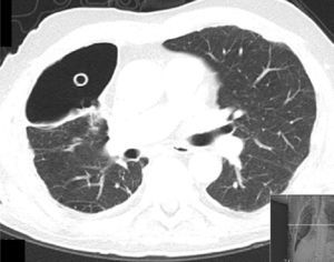 Thoracic CT scan showing pleural cavity with a chest tube inside and pleural thickening.