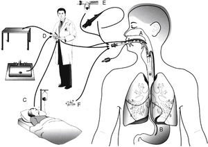 Routes of colonization/infection in mechanically ventilated patients21 A – oral and pharyngeal colonization; B – gastric colonization; C – infected patients; D – handling of respiratory equipment; E – use of respiratory devices; and F – aerosols from contaminated air.