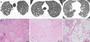 Patient's parenchymal lung disease – imaging and lung biopsy. (A) Chest CT images with interlobular thickening pattern with reticulation, micronodulation and small scattered areas of ground-glass and lobular opacities. Alveolar proteinosis depicted by diffuse alveolar flooding by eosinophilic proteinaceous material, chronic lymphocytic infiltrate and septal fibrosis with collagen deposition.