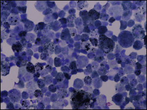 BAL from a patient with RB-ILD with an increased number of intense brown pigment-laden macrophages.