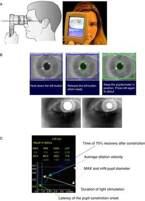 Procedure for measurement of pupillary light reflexes and pupil sizes and pupillometer displaying results. (A) The sequence of figures represent the adequate position to perform the scan: at the right angle to the patient's axis of vision, in a good alignment, closely adapted to the face and the pupil in the center of LCD screen. (B) The sequence of figures presents the pupil measurement phases: targeting phase (1), ready phase (2) and measurement phase. (C) Pupillometer display of one measurement results.