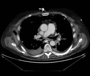 CT image showing a bronchial dehiscence in posterior aspect of a left bronchial suture after double-lung transplantation.