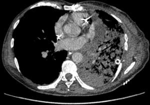 CT image showing extensive lung infiltrates in lower left lobe resulting from lower pulmonary vein obstruction.