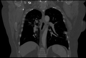 CT coronal section showing left thoracotomy dehiscence after left single-lung transplantation.