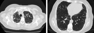 High-resolution chest tomography in patient no. 1 shows pleural and subpleural thickening with fibrotic changes in the marginal parenchyma, mainly in the upper lobes.