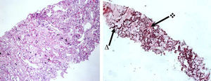 Histological features of patient no. 1 shows a sub-pleural elastotic fibrosis highlighted by the orcein elastic stain, that marks the alveolar walls elastosis (Δ) and the intra-alveolar fibrosis () (H&E, 100×; Orcein, 40×).