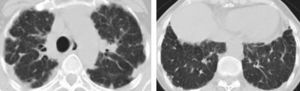 High-resolution chest tomography in patient no. 2 shows a pleural thickening with associated subpleural fibrosis, mainly in the upper lobes.