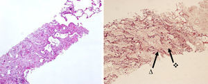 Histological features of patient no. 2 shows the sharped transition between normal lung parenchyma and the fibroelastotic lesion; orcein elastic stain marks the alveolar walls elastosis (Δ) and the intra-alveolar fibrosis () (H&E, 40×, 100×).