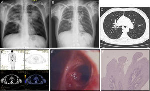 Chest X-ray before (A) and after (B) antibiotic treatment for pneumococci pneumonia. (C) Computed tomography scan showing diffuse thickened bronchial walls and small bronchiectasis in the upper left lobe. (D) Positron-emission tomography/Computed tomography with 18-fludeoxyglucose (FDG) displaying increased metabolic activity in the right hilum region. On bronchoscopic examination (E), a cauliflower lesion was observed on the posterior segment of the right upper bronchus. (F) High-power microscopic appearance of fibrovascular cores surrounded by squamous epithelium (original magnification 100×, haematoxylin and eosin stain).
