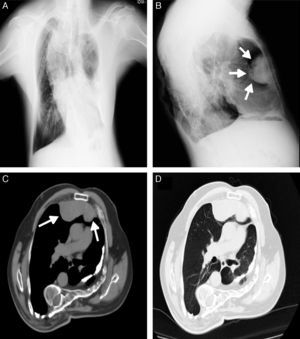 (A) Chest X-ray showing a marked thoracic deformity; (B) chest X-ray showing a large retrosternal opacity; (C and D) chest CT showing a retrosternal lobulated mass at the right hemithorax with 10.2×3.7cm.