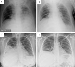 Case 1 (A – anterior–posterior chest radiograph before the CIT; B – anterior–posterior chest radiograph after the CIT). Case 2 (C – posterior–anterior chest radiograph before the CIT; D – posterior–anterior chest radiograph after the CIT).