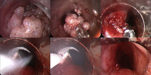 Rigid bronchoscopy performed to treat severe tracheal obstruction caused by the large papillomata, with complete repermeabilization and final cryo-coagulation of the mass base.