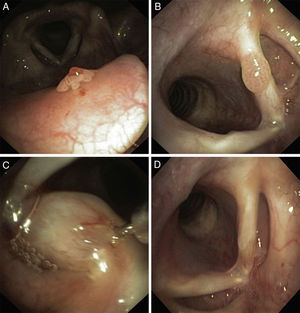 (A) Small papilloma in epiglottis (B) Papilloma of the left vocal cord (before cidofovir), (C) Intralesional injection of cidofovir, (D) Complete remission (after treatment).
