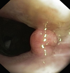 Polyploid papilloma on the posterior commissure of the vocal cords.