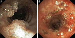 Tracheal papillomas treated with laser vaporization and posterior injection of cidofovir at the base of the lesions: (A) before (B) after endoscopic treatment.