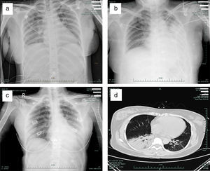 Representative radiographic findings in the pregnant and non-pregnant H7N9 patients. (a) Chest radiograph of case 1 (pregnant) taken on admission, showing bilateral pulmonar patchy high density shadows; (b) Chest radiograph of case 2 taken on admission, showing a patchy, high density shadow in the middle-inferior lobe of the left lung; (c) Chest radiograph of case 3 taken on admission, showing a patchy, high density shadow of the inferior lobe of the left lung; (d) CT scan of case 1 (pregnant) taken on admission, showing significant consolidation of the inferior lobe of the right lung and a patchy, high density area in the inferior lobe of the left lung.