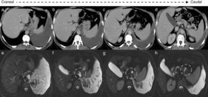 (a)–(d) Axial thoracoabdominal CT scan: large volume left pleural effusion; signs of chronic pancreatitis-diffuse pancreatic calcifications, (d) pancreatopleural fistulous tract – dashed circles. (e)–(h) MRCP axial planes: allow for a better depiction of the fistulous tract communicating with the pleural space through the aortic hiatus – dashed circles.