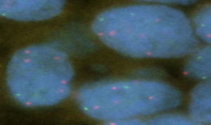Case 7: FISH positive for EGFR/chromosome 7 centromere. Gene high polysomy; EGFR – red signal, chromosome 7-green. 1000×.