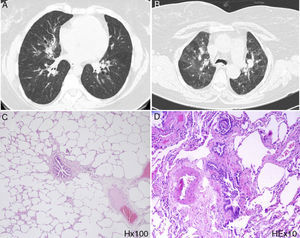 Radiological and histological features observed in the described clinical cases (Case 1: A and C, Case 2: B and D). (A) Chest CT images with cystic and varicose bronchiectasis, as well as peribronchovascular reticulation. (B) Chest CT images confirming the presence of parenchymal densifications, bilateral ground glass opacities and predominance of a mosaic pattern. (C) Photomicrograph illustrating the presence of agglomerates of collagen surrounding the bronchovascular axes with widespread alveolar distension, resulting in concentric narrowing and obliteration. H stain, 100× original magnification. (D) Photomicrograph illustrating the presence of fibroblast proliferation associated with collagen deposition, as well as alveolar and septal rupture and centrilobular emphysema. These features result in constriction of the airway lumen, which is compatible with the definitive diagnosis of constrictive bronchiolitis. H&E stain, 100× original magnification.