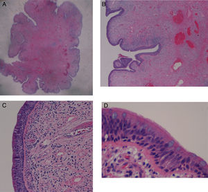 (A and B) Low power view, hematoxylin and eosin staining showing a polypoid lesion with a fibrovascular connective tissue axis; (C and D) high-power view, hematoxylin and eosin staining, showing a ciliated cylindrical epithelium with an inflammatory infiltrate.
