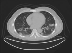 Interstitial lung disease preceding primary biliary cirrhosis in a male ...