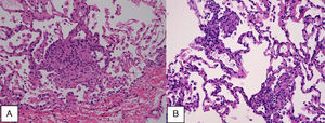 Poorly formed granulomas occupying alveolar spaces (A) (H&E high power), associated to interstitial lympho-plasmocitary infiltrate, (B) (H&E high power).