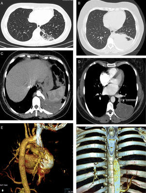(A) The first chest CT performed, showing a heterogeneous posteromedial consolidation in the left lower lobe comprising multiple cysts. (B) The second chest CT showing posteromedial hepatization of the left lower field, compatible with superimposed infection. (C) CT angiography showing the anomalous artery arising from the thoracic aorta. (D) CT angiography images showing the venous drainage (arrow) to the pulmonary veins. (E–F) 3D CT reconstructions showing the anomalous artery.