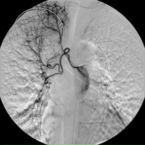 Selective catheterisation of the right intercostobronchial trunk. Circle: bronchial-to-pulmonary retrograde shunts in the right apex.