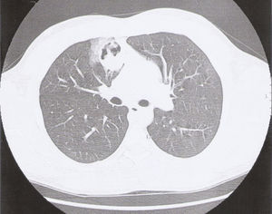 Ovoid mass in the first CT of the chest.