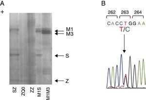 Characterization of Q0Gaia allele. (A) Protein gel electrophoresis. Index case ZQ0 displays only a band corresponding to PI*Z allele. (B) Electropherogram of the index case. The arrow shows the region of the T to C mutation in codon 263.