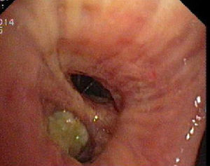 Video-bronchoscopy showing a yellowish mass in the lingular division of the LUL.