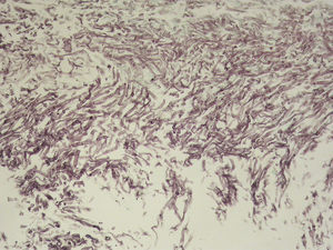 Histological examination showing small plugs constituted by fungal structures of Aspergillus species.