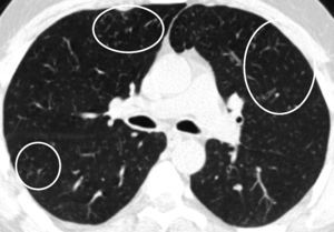 Axial CT image at lung window setting showing centrilobular ground-glass nodules (circles).