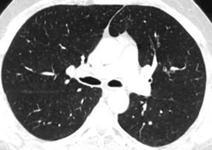 Axial CT image at the same level as in Fig. 1a showing disappearance of ground-glass nodules.