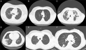 Radiological features (Chest CT images) observed in some of the enrolled clinical cases. (A) Image revealing reticularnodular infiltrates, associated with areas of ground glass opacities. These features are consistent with UIP pattern and can be observed in various types of bronchiolitis, such as obliterative, constrictive, chronic and follicular bronchiolitis. (B) Diffuse micronodular pattern usually present in conditions related to tobacco, particularly in cases of respiratory bronchiolitis. A centrilobular emphysema in the upper lobes and thickened bronchial walls are also noted. (C) Extensive parenchymal changes, densification with areas of ground-glass bilaterally and (D) areas of consolidation associated with air bronchogram. These patterns can be found in various types of bronchiolitis, such as obliterative and constrictive bronchiolitis. (E) Subpleural nodule in the left upper lobe which may be associated with respiratory or obliterative bronchiolitis. (F) In the upper segment of the right lower lobe, a grossly nodular densification is observed, which may be present in almost all the histopathological types of Bronchiolitis.